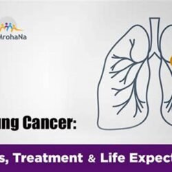 treatment for lung cancer stage 1