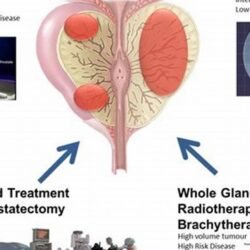 treatment options of prostate cancer