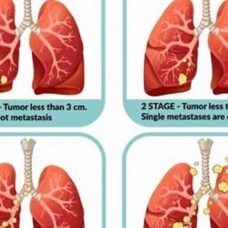 treatment for lung cancer stage 4