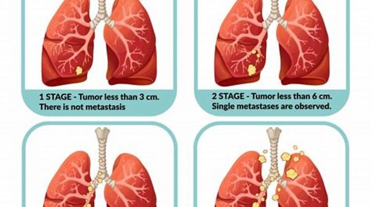 treatment for lung cancer stage 4