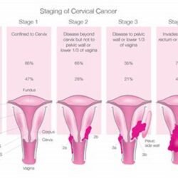 stage 3 cervical cancer life expectancy with treatment