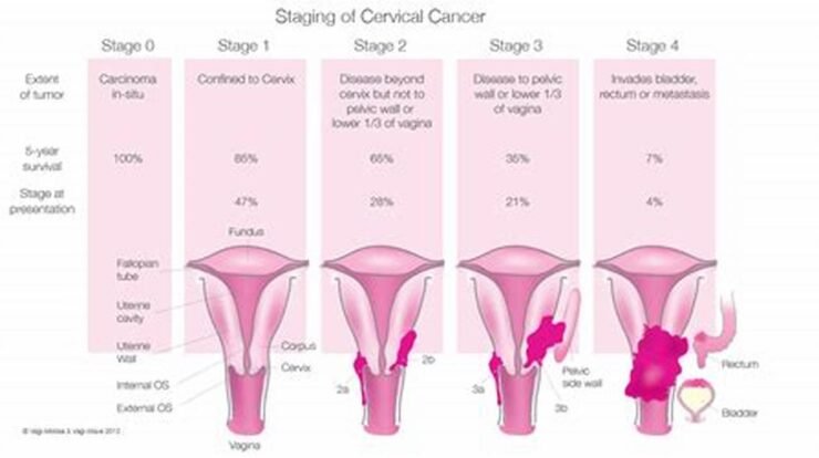 stage 3 cervical cancer life expectancy with treatment