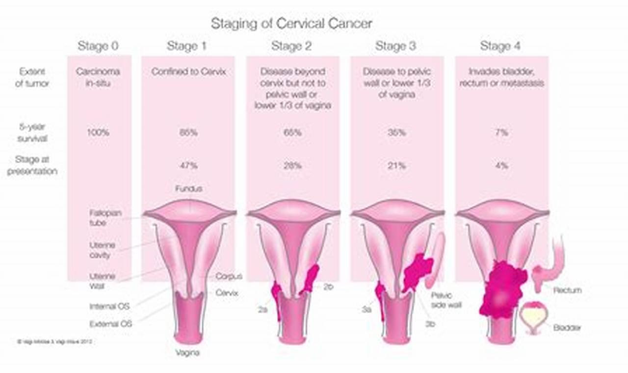 stage 3 cervical cancer life expectancy with treatment